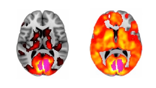 scan c&eacute;r&eacute;bral lsd